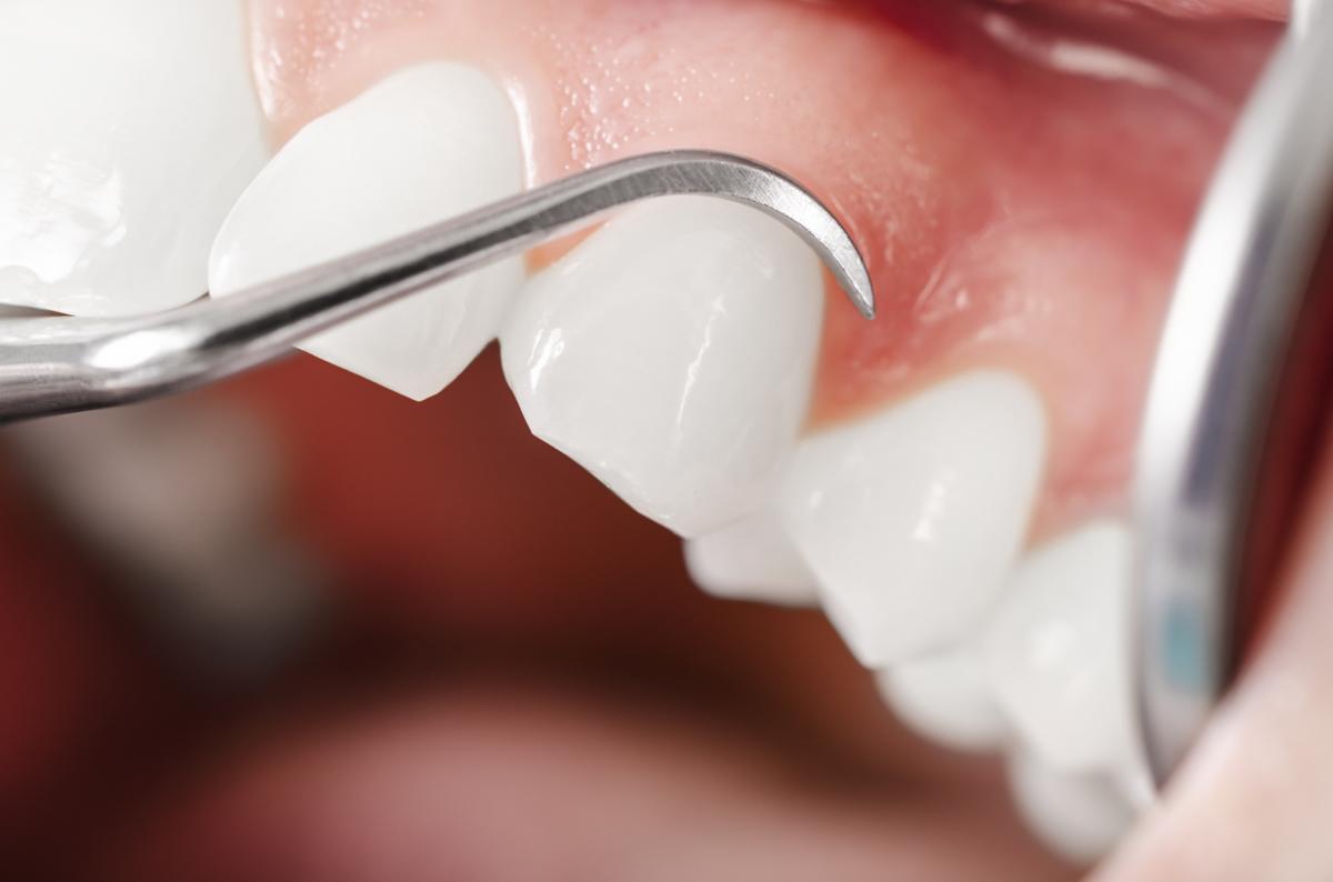 periodontal-therapy.jpg