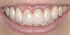 Before & After Dental Gallery