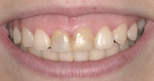 Before & After Dental Gallery