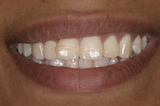 Before & After Dental Gallery