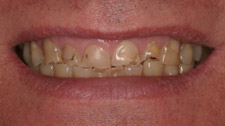 Before & After Dental Gallery