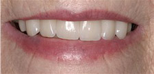 Before & After Dental Gallery