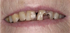Before & After Dental Gallery
