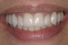 Before & After Dental Gallery