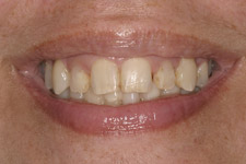 Before & After Dental Gallery