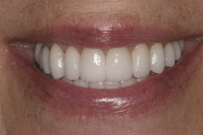 Before & After Dental Gallery