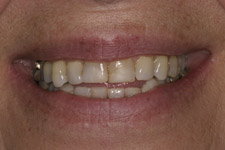 Before & After Dental Gallery