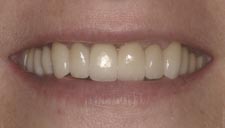 Before & After Dental Gallery