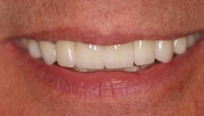 Before & After Dental Gallery