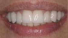 Before & After Dental Gallery