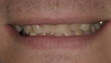 Before & After Dental Gallery