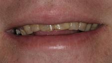 Before & After Dental Gallery