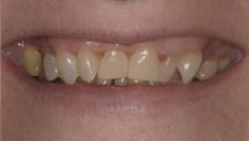 Before & After Dental Gallery