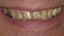 Before & After Dental Gallery