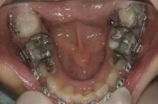 Before & After Dental Gallery