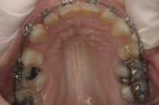 Before & After Dental Gallery