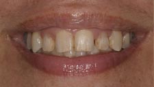 Before & After Dental Gallery