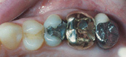 Porcelain Crowns