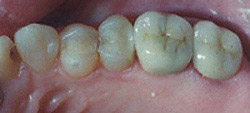 Porcelain Crowns