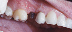 Dental Implants ~ The Perfect Fit