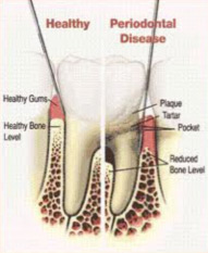 Periodontal Therapy