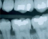 Periodontal Therapy