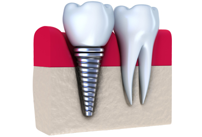 dental implants