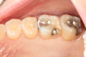 Mercury Removal