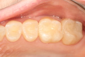 Mercury Removal