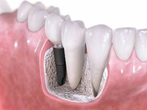 Should I get Dental Implants?