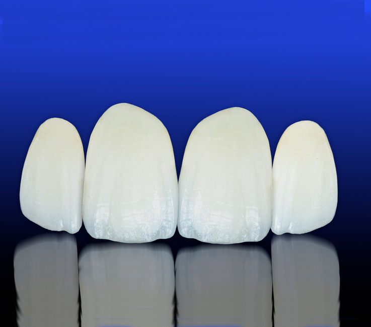 Porcelain Veneers Explanined