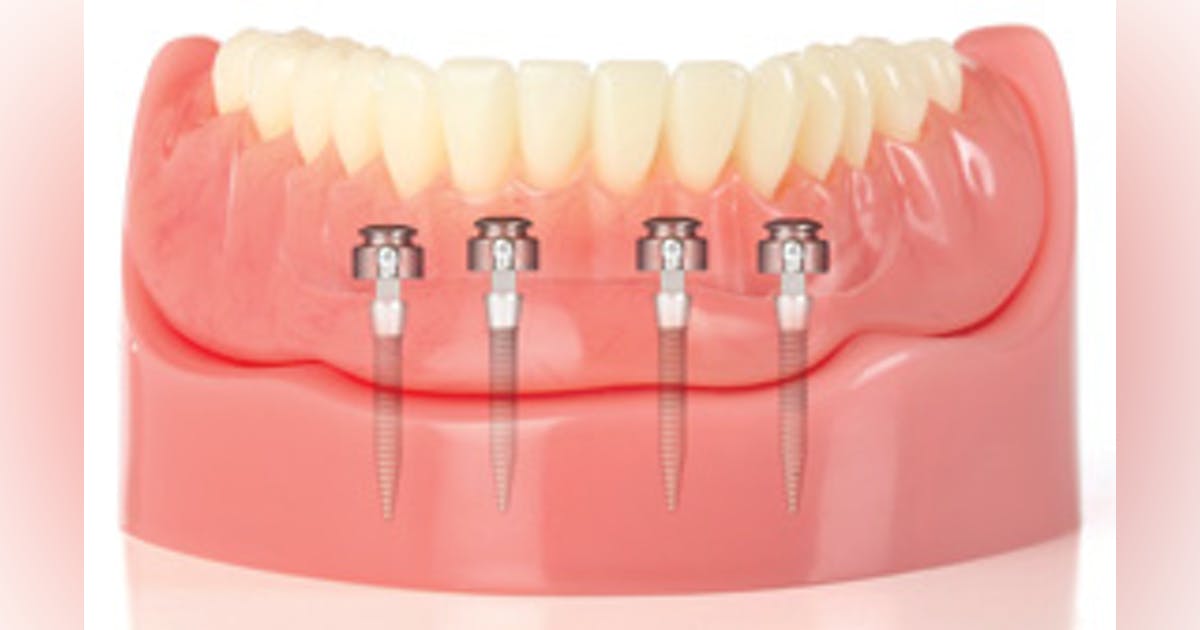 Mini-Implants vs Dental Implants