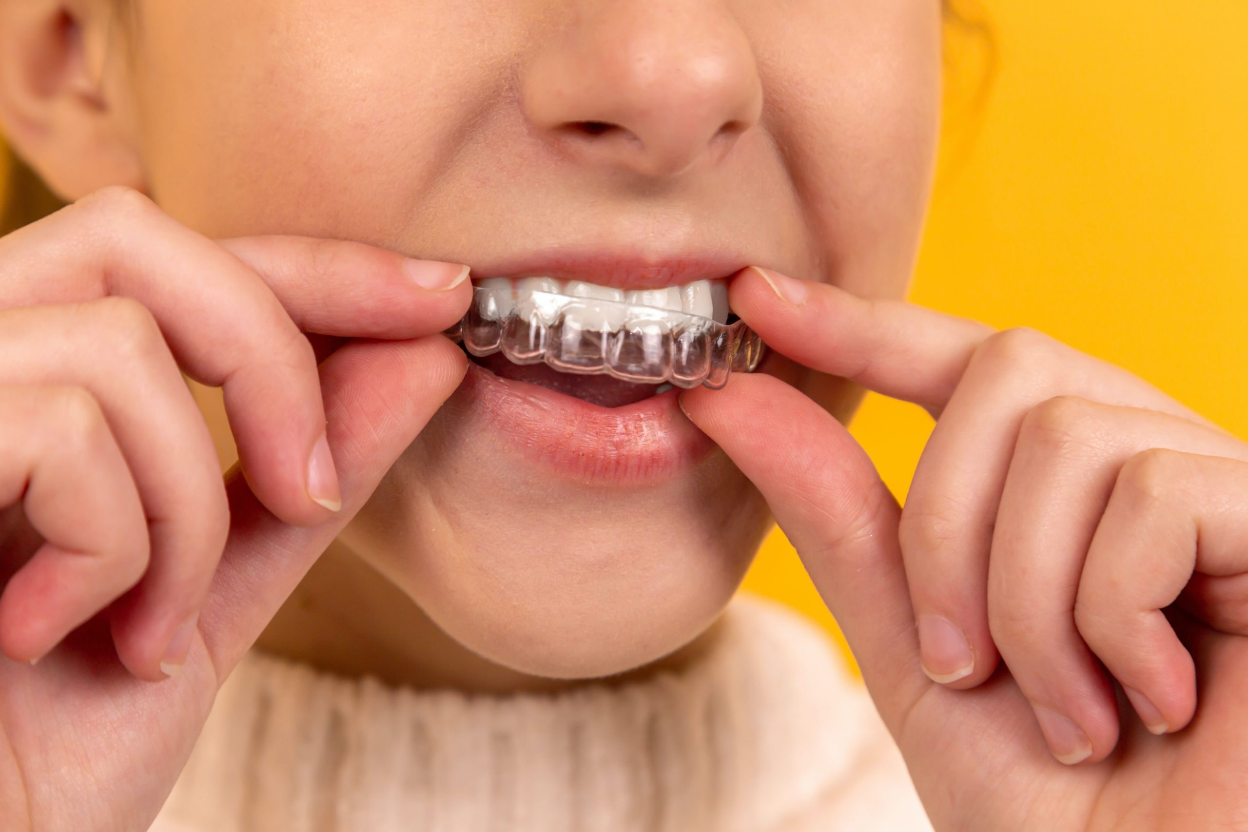 Clearline Braces vs Traditional Braces-Pros and Cons